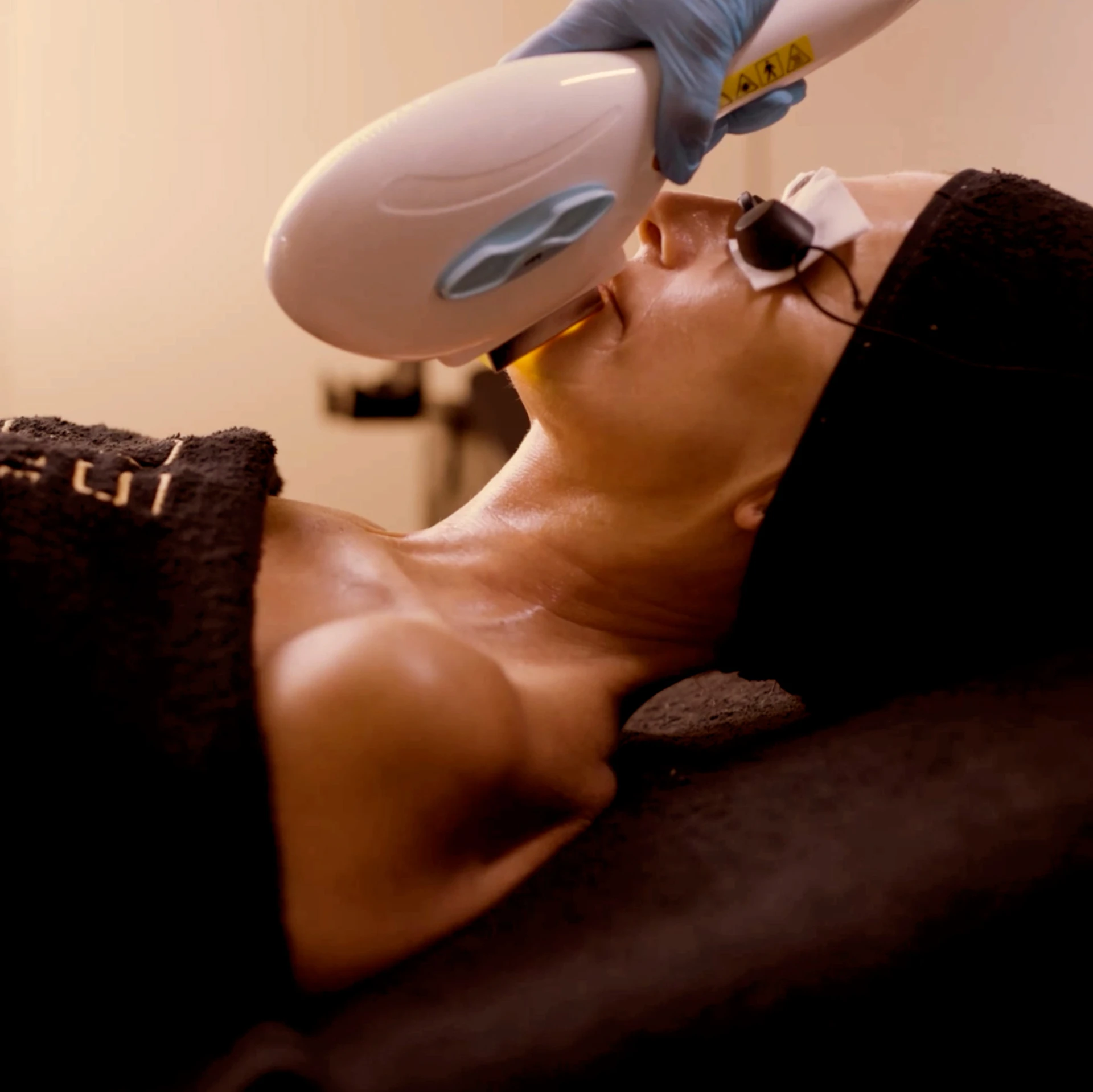 Destellos IPL facial en Star Wappas